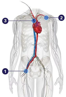 TAVR body anatomy 3 callouts